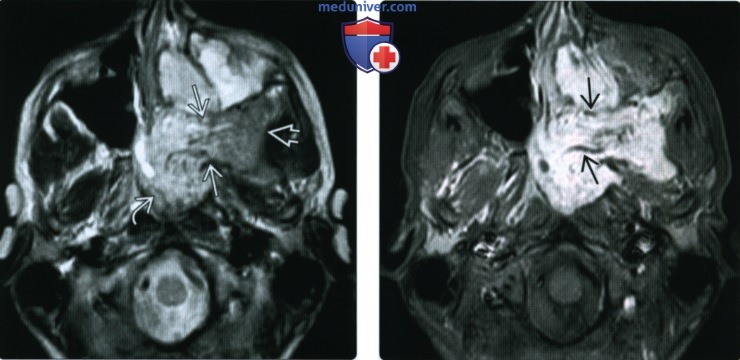 КТ, МРТ при ювенильной ангиофиброме носа