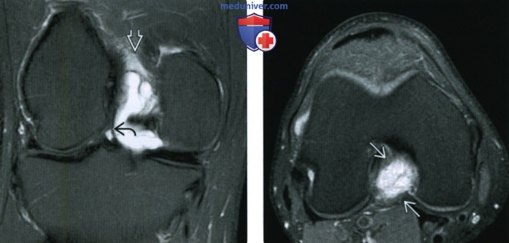 КТ, МРТ при кисте межмыщелковой вырезки коленного сустава