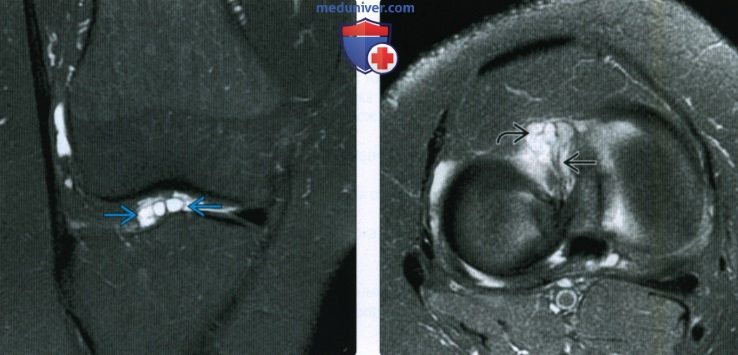 КТ, МРТ при кисте межмыщелковой вырезки коленного сустава