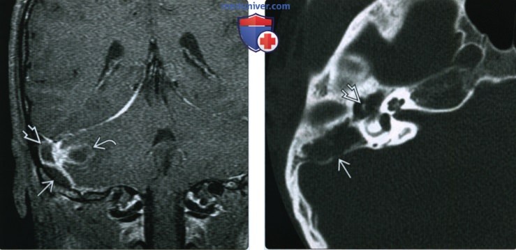КТ, МРТ при коалесцентном отомастоидите и его осложнениях