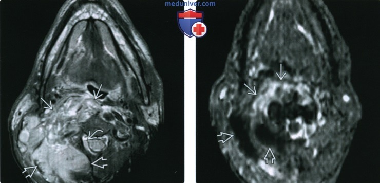 КТ, МРТ при неходжкинской лимфоме головы и шеи