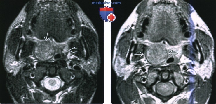 КТ, МРТ при неходжкинской лимфоме слизистого пространства глотки
