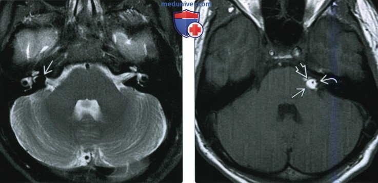 КТ, МРТ при липоме мостомозжечкового угла (ММУ) и внутреннего слухового канала (ВСК)