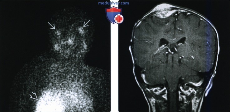 КТ, МРТ при метастатической нейробластоме головы и шеи