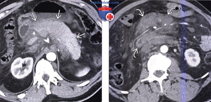 КТ, МРТ признаки метастаза в поджелудочную железу и лимфомы поджелудочной железы