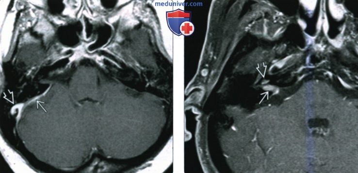 КТ, МРТ при метастазе в мостомозжечковый угол (ММУ) и внутренний слуховой канал (ВСК)