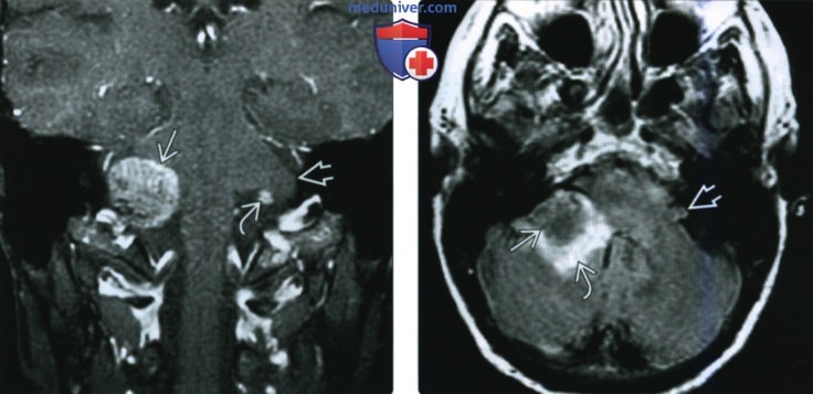 КТ, МРТ при метастазе в мостомозжечковый угол (ММУ) и внутренний слуховой канал (ВСК)