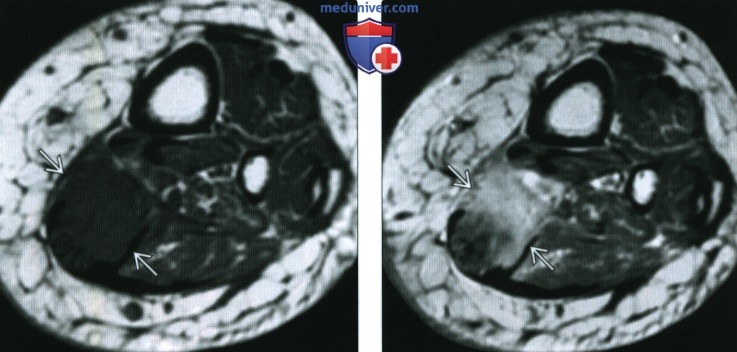 КТ, МРТ при метастазах опухоли в мягкие ткани