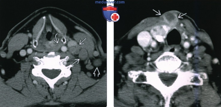 КТ, МРТ при метастазах плоскоклеточного рака головы и шеи в лимфатические узлы