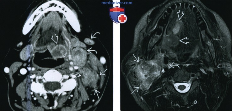 КТ, МРТ при метастазах плоскоклеточного рака головы и шеи в лимфатические узлы
