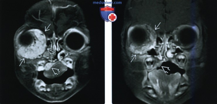КТ, МРТ при младенческой гемангиоме головы и шеи