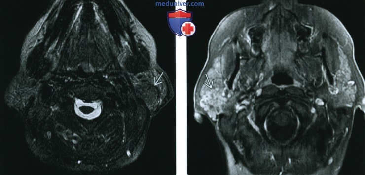 КТ, МРТ при мукоэпидермоидном раке околоушной железы