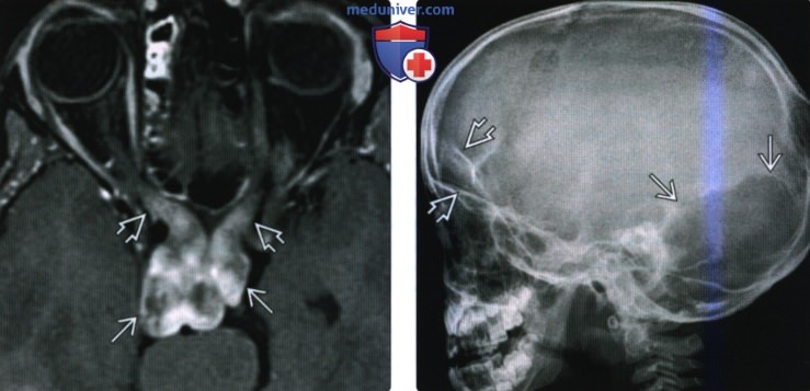 КТ, МРТ при нейрофиброматозе первого типа головы и шеи