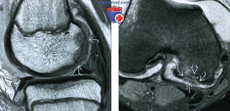 КТ, МРТ оценка хряща коленного сустава после операции