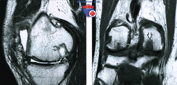 КТ, МРТ оценка хряща коленного сустава после операции