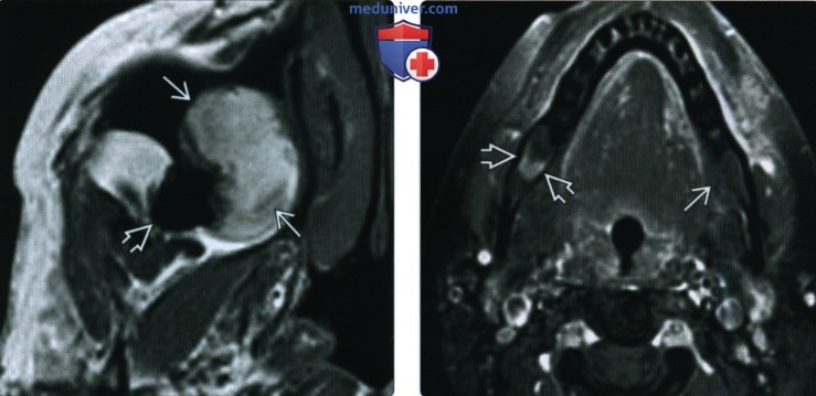 КТ, МРТ при одонтогенной кератокисте (кератокистозной одонтогенной опухоли)