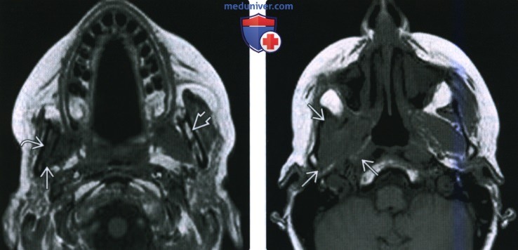 КТ, МРТ при периневральной опухолевой инвазии жевательного пространства по нижнечелюстному нерву
