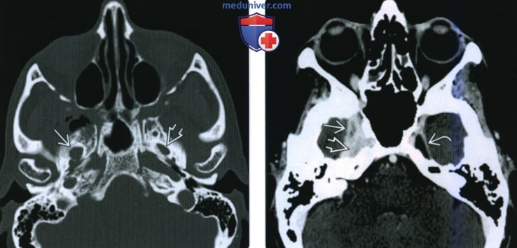 КТ, МРТ при периневральной опухолевой инвазии жевательного пространства по нижнечелюстному нерву