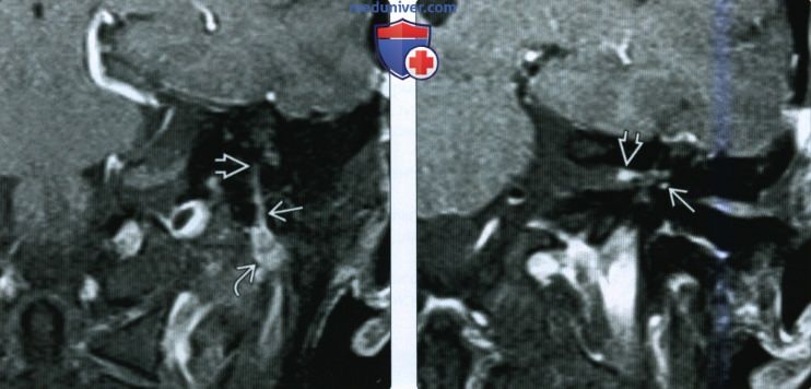 КТ, МРТ при периневральном распространении злокачественной опухоли околоушной слюнной железы в височную кость