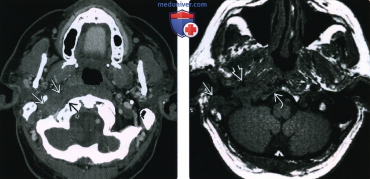 КТ, МРТ при остеомиелите основания черепа