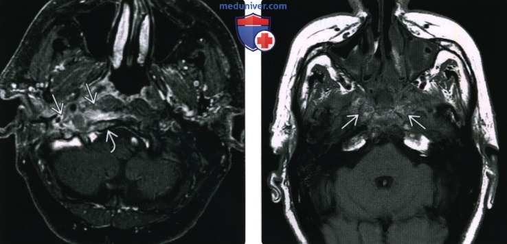 КТ, МРТ при остеомиелите основания черепа