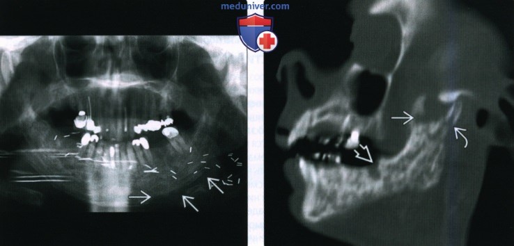 КТ, МРТ при остеорадионекрозе нижней и верхней челюсти