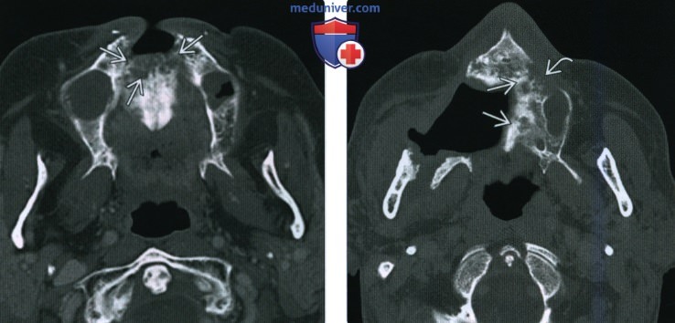 КТ, МРТ при остеорадионекрозе головы и шеи