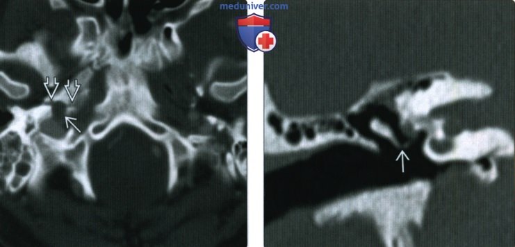 КТ, МРТ при переломе височной кости
