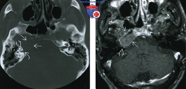 КТ, МРТ при плазмоцитоме основания черепа