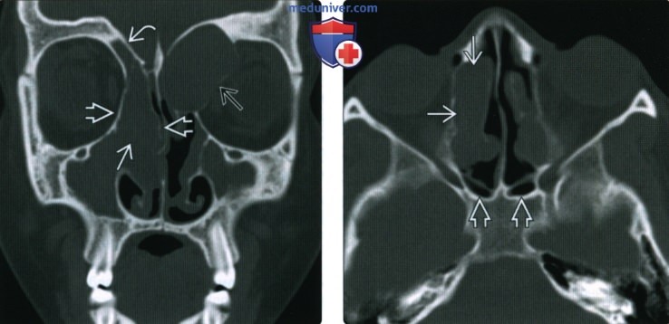 КТ, МРТ при полипозе носа и пазух