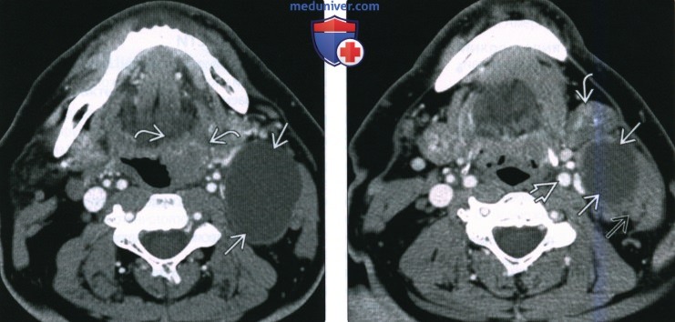 КТ, МРТ при ВПЧ-обусловленном плоскоклеточном раке ротоглотки