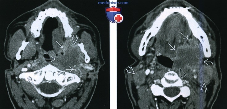КТ, МРТ при ВПЧ-обусловленном плоскоклеточном раке ротоглотки