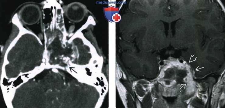 КТ, МРТ при рабдомиосаркоме височной кости