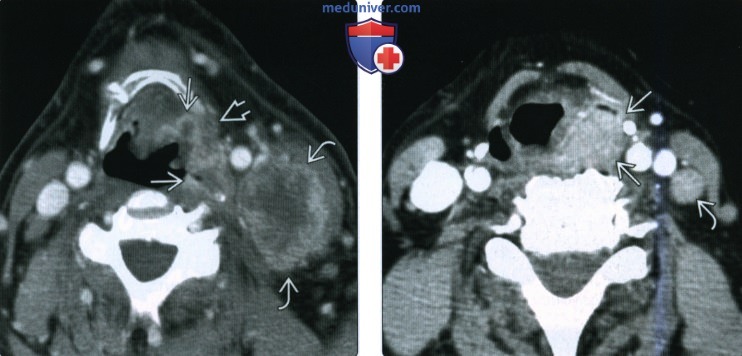 КТ, МРТ при плоскоклеточном раке грушевидного синуса