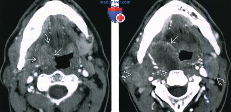 КТ, МРТ при плоскоклеточном раке небной миндалины