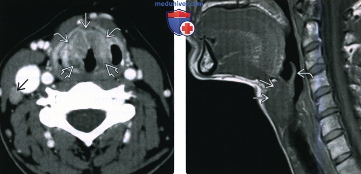 КТ, МРТ при плоскоклеточном раке преддверия гортани