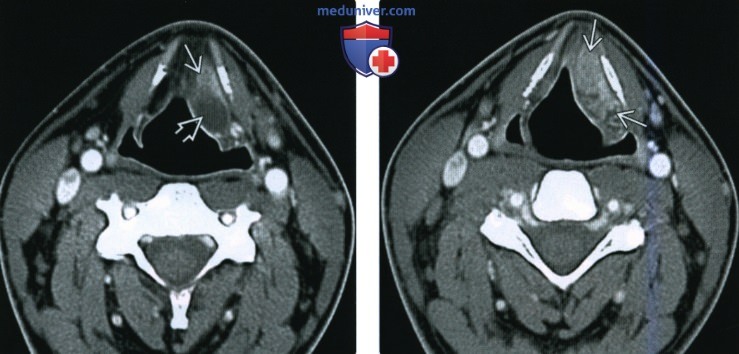 КТ, МРТ при плоскоклеточном раке преддверия гортани