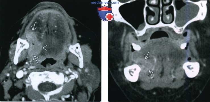 КТ, МРТ при плоскоклеточном раке тела и верхушки языка