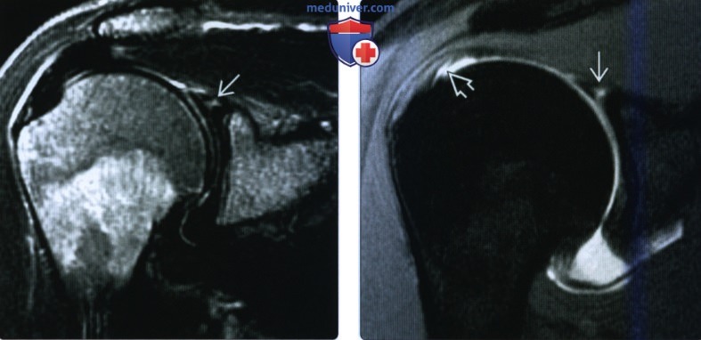 КТ, МРТ при переднем и заднем разрыве верхней губы плечевого сустава