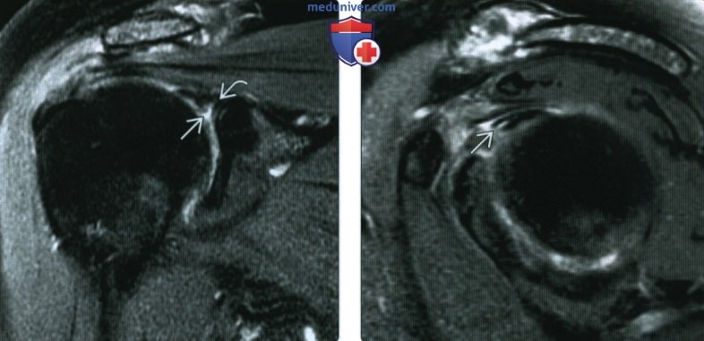 КТ, МРТ при переднем и заднем разрыве верхней губы плечевого сустава