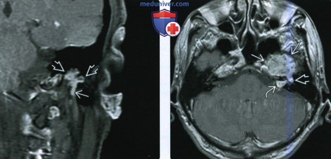КТ, МРТ при шванноме интратемпорального лицевого нерва