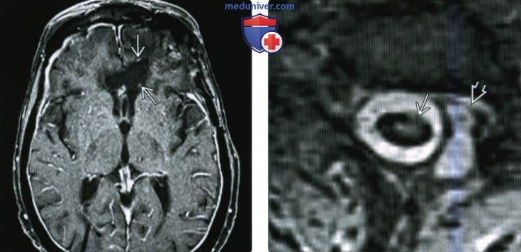 КТ, МРТ при поверхностном сидерозе мостомозжечкового угла (ММУ) и внутреннего слухового канала (ВСК)