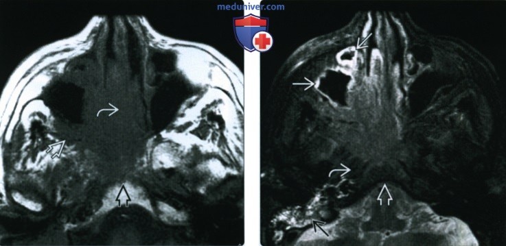 КТ, МРТ при синоназальном плоскоклеточном раке
