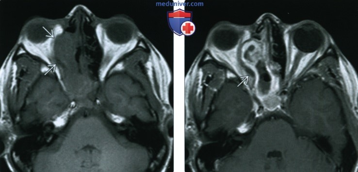 КТ, МРТ при синоназальной оссифицирующей фиброме