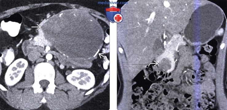 КТ, МРТ признаки солидной и псевдопапиллярной опухоли поджелудочной железы (СППО)