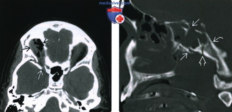 КТ, МРТ при травме основания черепа