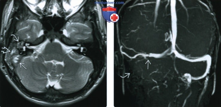 КТ, МРТ при тромбозе синуса твердой мозговой оболочки в области основания черепа