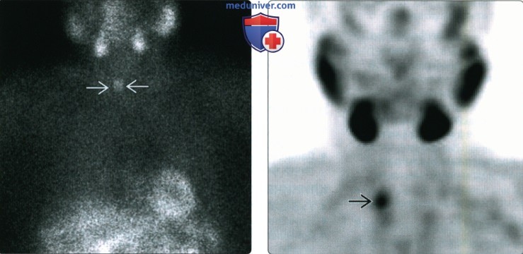КТ, МРТ, УЗИ при аденоме паращитовидной железы в висцеральном пространстве