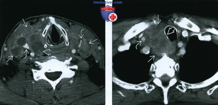 КТ, МРТ, УЗИ при анапластическом раке щитовидной железы