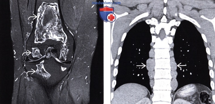 КТ, МРТ, УЗИ, рентгенография брюшной полости при серповидноклеточной анемии